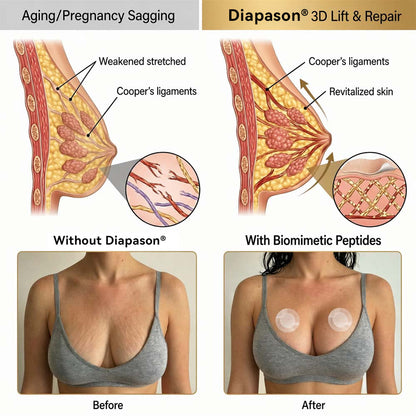 💥Diapason® 💥𝐁𝐑𝐄𝐀𝐒𝐓 𝐕𝐎𝐋𝐔𝐌𝐄 𝐁𝐎𝐎𝐒𝐓 & 𝐅𝐈𝐑𝐌 𝐌𝐈𝐂𝐑𝐎-𝐍𝐄𝐄𝐃𝐋𝐄 𝐏𝐀𝐓𝐂𝐇𝐄𝐒  ❤️