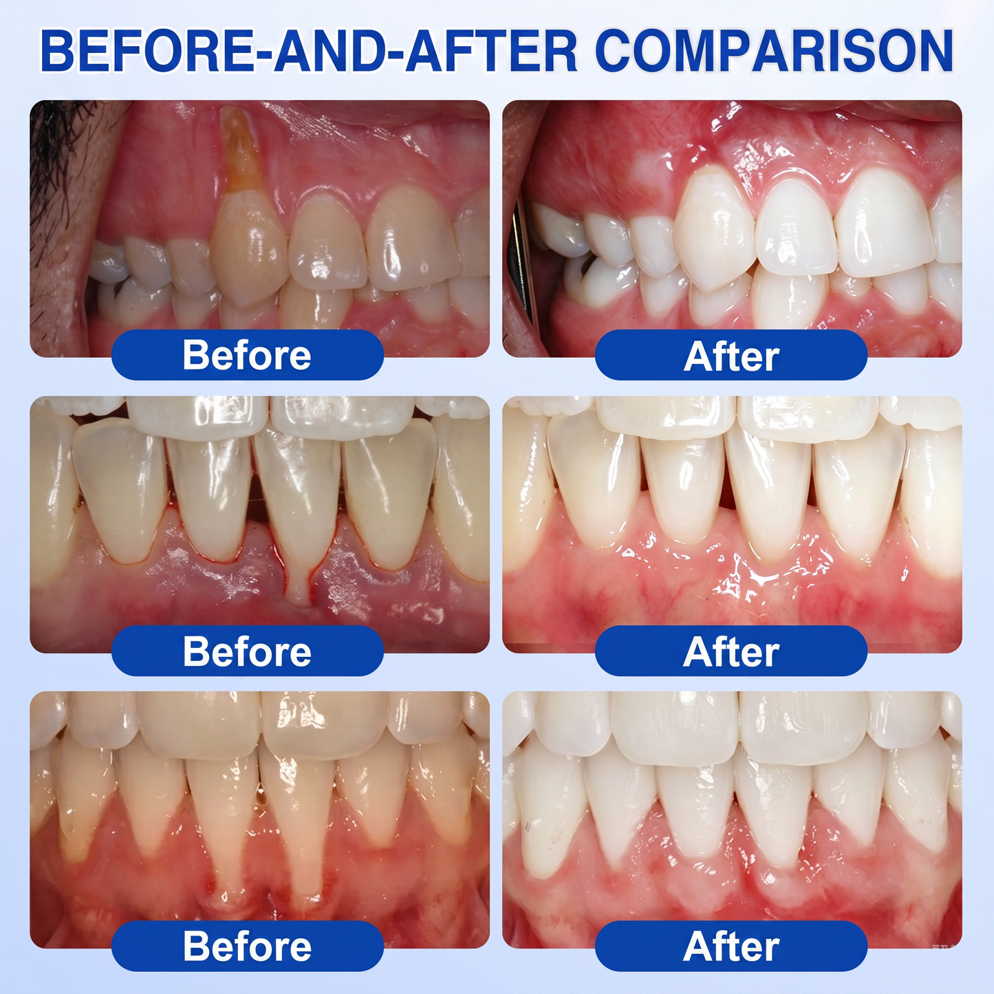 Glimmerly®👀GumRevive periodontal repair gel