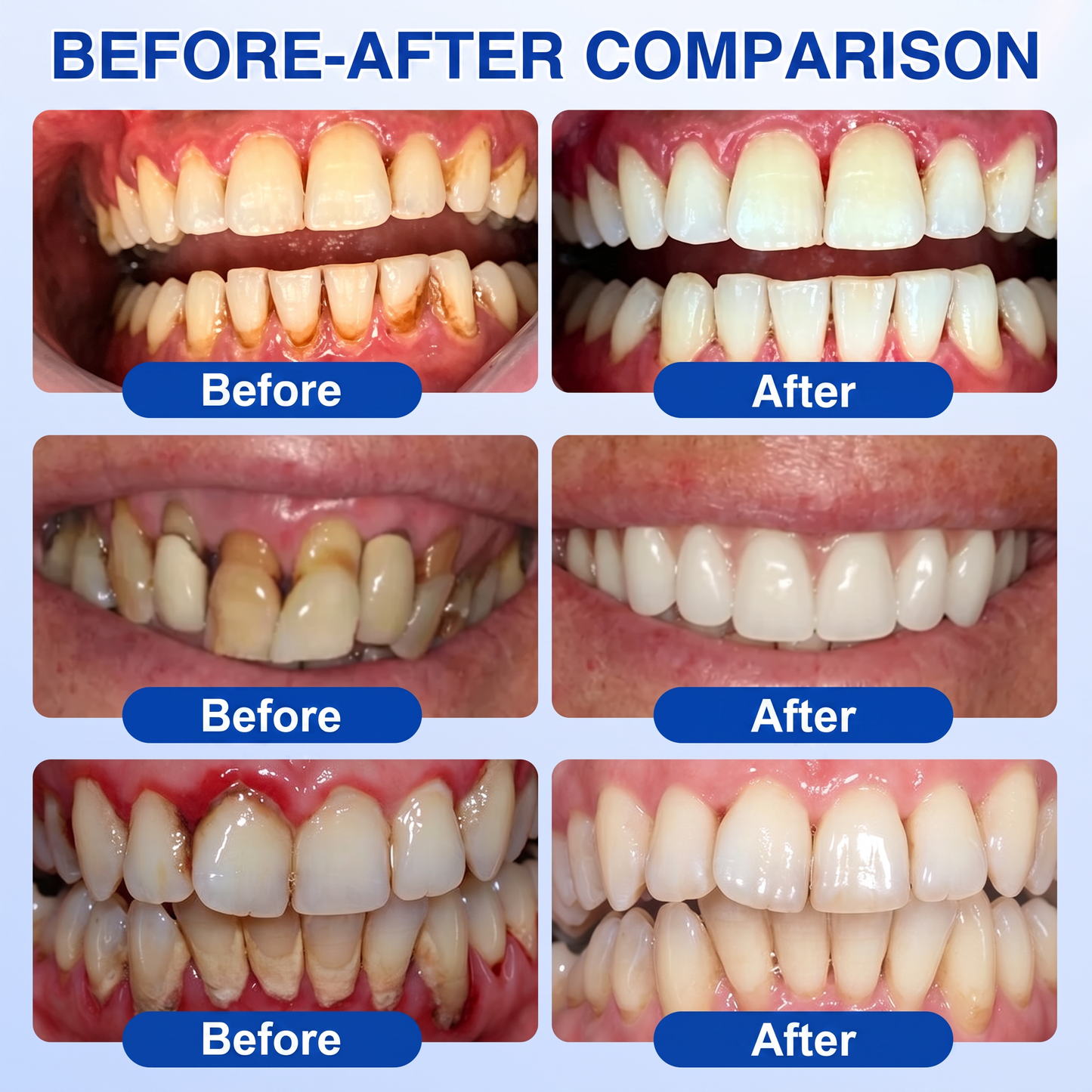 Glimmerly®👀GumRevive periodontal repair gel