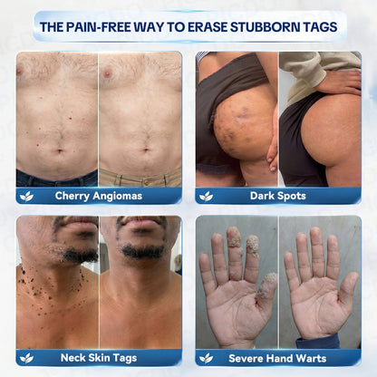 𝐎𝐟𝐟𝐢𝐜𝐢𝐚𝐥 𝐁𝐫𝐚𝐧𝐝 𝐒𝐭𝐨𝐫𝐞 💎 | 𝐏𝐢𝐜𝐝𝐨® 7-𝐃𝐚𝐲 𝐒𝐤𝐢𝐧 𝐓𝐚𝐠 & 𝐒𝐩𝐨𝐭 𝐄𝐫𝐚𝐬𝐞𝐫 𝐂𝐫𝐞𝐚𝐦  (Zero Pain, Zero 𝐒𝐜𝐚𝐫𝐬 Formula)  💎