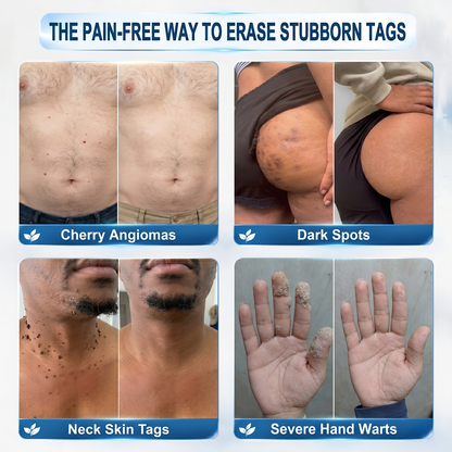 𝐏i𝐜𝐝o® 7-𝐷𝑎𝑦 𝗧𝐚𝐠 & 𝗦𝗽𝐨𝐭 𝐄𝐫𝒂𝒔𝒆𝒓(Zero Pain, Zero 𝐒𝐜𝐚𝒓𝒔 Rollerball) 🔊
