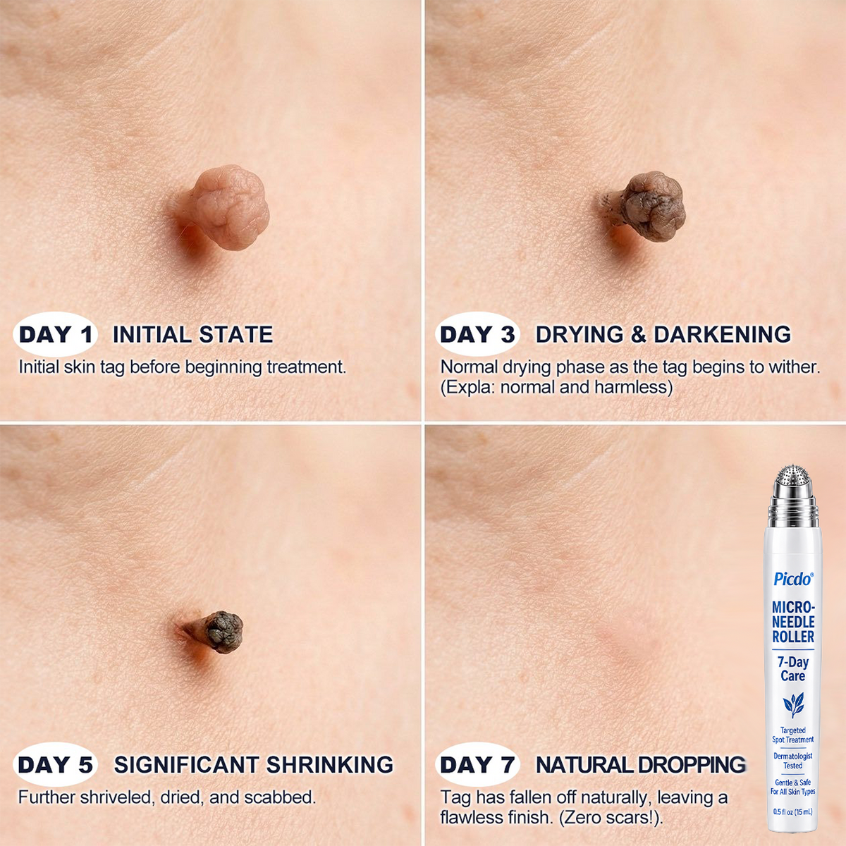 𝐏i𝐜𝐝o® Advanced Skin Tag & Wart Removal Roller