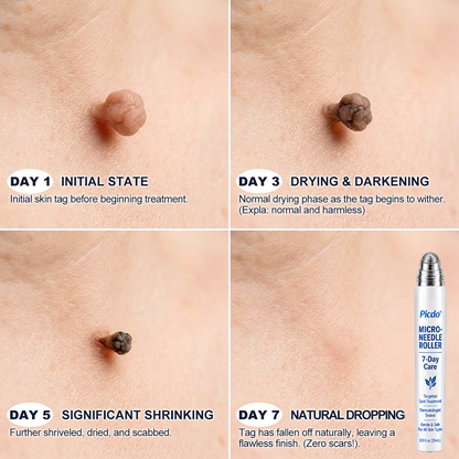𝐏i𝐜𝐝o® Advanced Skin Tag & Wart Removal Roller
