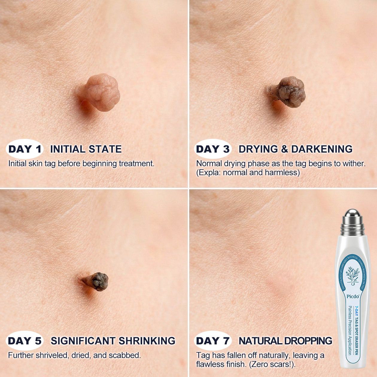𝐏i𝐜𝐝o® 7-𝐷𝑎𝑦 𝗧𝐚𝐠 & 𝗦𝗽𝐨𝐭 𝐄𝐫𝒂𝒔𝒆𝒓(Zero Pain, Zero 𝐒𝐜𝐚𝒓𝒔 Rollerball) 🔊