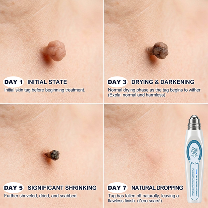 𝐏i𝐜𝐝o® 7-𝐷𝑎𝑦 𝗧𝐚𝐠 & 𝗦𝗽𝐨𝐭 𝐄𝐫𝒂𝒔𝒆𝒓(Zero Pain, Zero 𝐒𝐜𝐚𝒓𝒔 Rollerball) 🔊